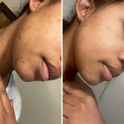 Exfoliating Turmeric Kojic Acid Pads