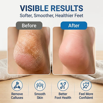 Rechargeable Electric Foot Scraper – 2-Speed Callus Remover with Vacuum