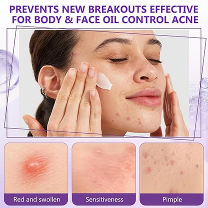 12% Azelaic Acid Face Cream – Brightening & Blemish Care Moisturizer