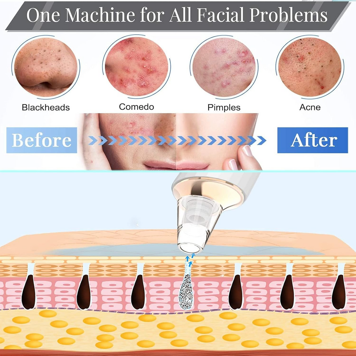 Blackhead Remover Pore Vacuum – USB Facial Pore Cleaning & Suction Device