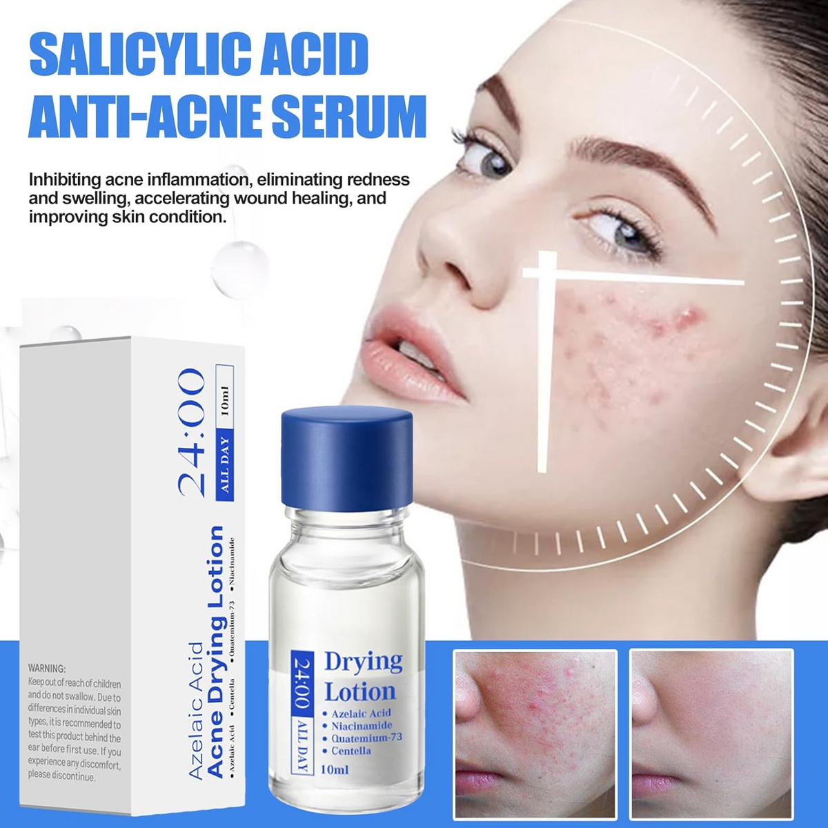 Salicylic Acid Spot Drying Lotion – Targeted Acne Care