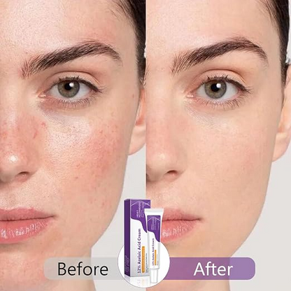 12% Azelaic Acid Face Cream – Brightening & Blemish Care Moisturizer