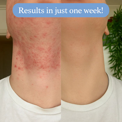 Ingrown Hair Treatment – Soothe, Clear & Prevent Razor Bumps