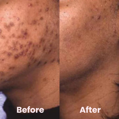 Turmeric Kojic Exfoliating Pads – Brighten, Smooth & Renew Skin Instantly